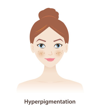 Hyperpigmentation, melasma, dark spots on woman face vector on white background. Skin pigment discoloration, darkened pigment, abnormally high amount of melanin. Skin pigment disorders concept.