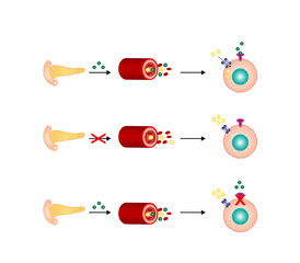 	
Diabetes mellitus type 1, pancreas's failure to produce enough insulin and type 2, cells fail to respond to insulin (Insulin resistance). Result in high blood glucose levels. Vector illustration