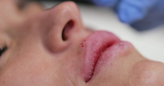 cosmetologist makes injections to enlarge the lips of beautiful woman. procedure lip augmentation