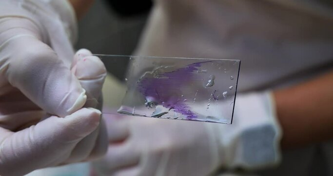 A gloved hand holds a stained blood smear. In the laboratory, a doctor holds a glass with a blood smear painted with purple paint. Blood smear prepared for microscopic examination.