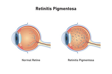 Retinitis Pigmentosa Syndrome Scientific Design. Vector Illustration. - obrazy, fototapety, plakaty