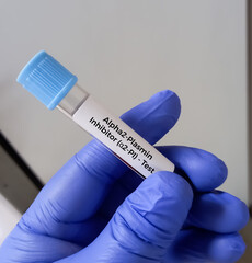 Blood sample for alpha-2-antiplasmin or alpha 2-Plasmin Inhibitor (a2PI) test. Use to screen for...