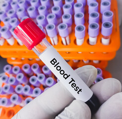 Technician holding test tube with blood sample for medical testing, biological analysis.