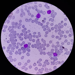 Leukemia. blood cells, blast cells and immature leukocytic cells in chronic lymphocytic leukemia,...