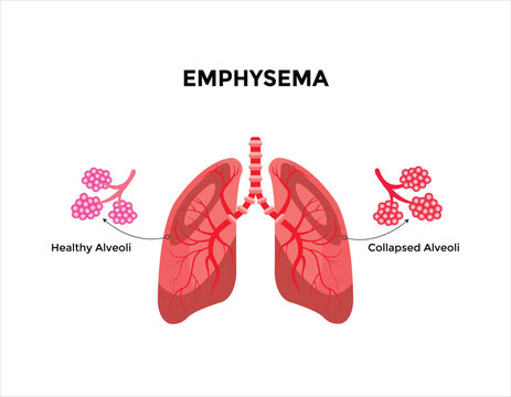 Emphysema disease concept. Damaged alveoli, failure airway. Floppy walls between air sacs in human lungs. 