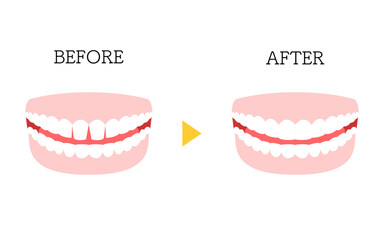 審美歯科、ダイレクトボンディングのビフォーアフター、隙間のある前歯