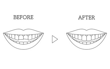 Cosmetic dentistry, direct bonding before and after, chipped tooth