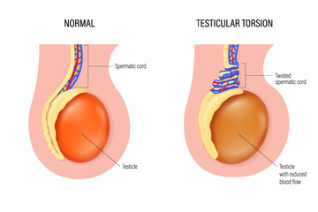 Testicular torsion vector. Comparison of normal and Testicular torsion. Testicular disease. Male reproductive system. - obrazy, fototapety, plakaty