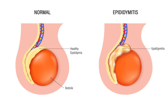 Epididymitis vector. Comparison of normal epididymis and Epididymitis. Testicular disease. Male reproductive system.