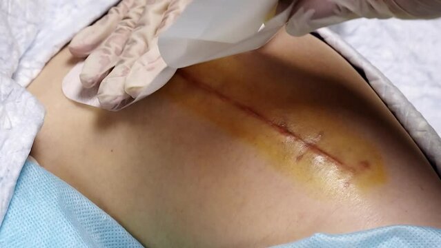 Top view of a suture on the thigh of a lying man, what the suture looks like 2 months after a total hip replacement, close up. Applying a sterile plaster to the treated seam