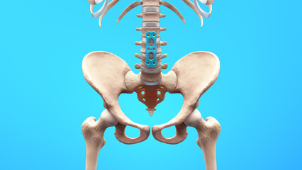 Orthopedic Spine Fixation Spinal Fixator Anterior Lumbar Plate	 - obrazy, fototapety, plakaty