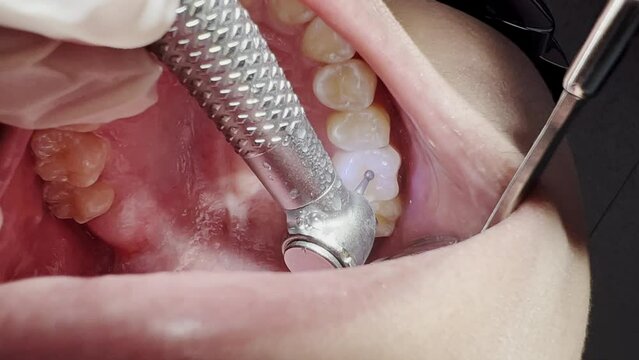 Close up shot of a dentist drilling a tooth to remove tooth cavity
