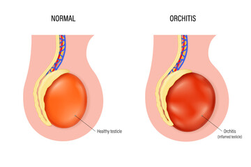 Orchitis vector. Comparison of normal testicle and orchitis. Testicular disease. Male reproductive system.
