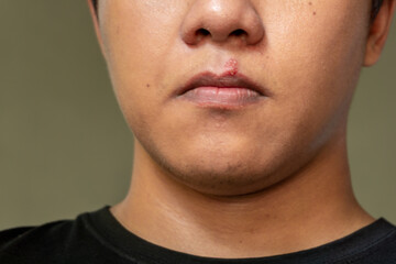 Herpes virus and infection treatment. Men lips affected  by herpes blisters