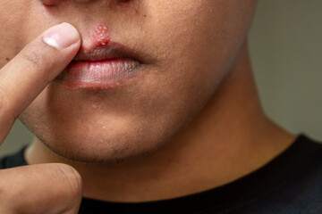 Herpes virus and infection treatment. Men lips affected  by herpes blisters