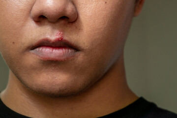 Herpes virus and infection treatment. Men lips affected  by herpes blisters