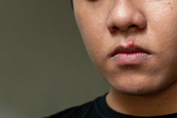 Herpes virus and infection treatment. Men lips affected  by herpes blisters