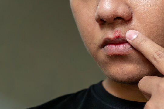 Herpes virus and infection treatment. Men lips affected  by herpes blisters