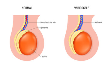 Varicocele vector. Comparison of normal testicular vein and varicocele. Testicular disease. Male reproductive system. - obrazy, fototapety, plakaty