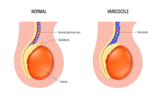 Varicocele vector. Comparison of normal testicular vein and varicocele. Testicular disease. Male reproductive system.