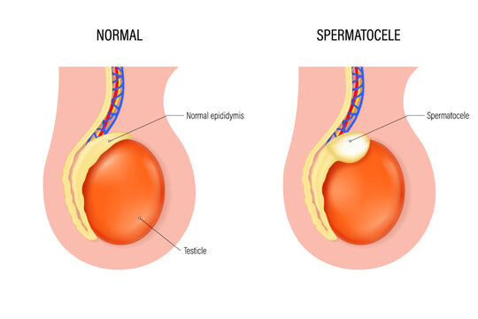Spermatocele vector. Comparison of normal epididymis and spermatocele. Testicular disease. Male reproductive system.