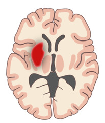 Cerebral hemorrhage (horizontal section)