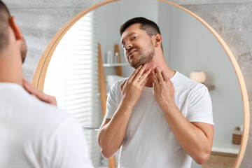 Man suffering from allergy looking at his neck in mirror indoors