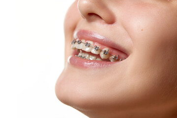 Cropped portrait of female model smiling with teeth in braces, which help solve problem of crooked...