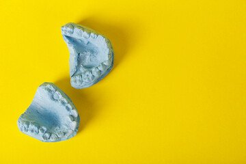 Blue plaster model of an impression of a patient's jaw at an orthodontist dentist on a yellow background. Manufacturing of dentures and crowns for dental prosthetics in orthodontics, macro.