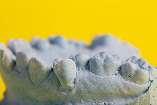 Blue plaster model of an impression of a patient's jaw at an orthodontist dentist on a yellow background. Manufacturing of dentures and crowns for dental prosthetics in orthodontics, macro. 