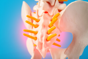 Model of the human spine, section of the inflamed coccyx with nerves on a blue background. Pinched nerve due to problems with the spine. Spondylolisthesis and spinal stenosis, - obrazy, fototapety, plakaty