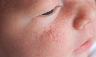 Allergic pimples in a newborn on the face. Pathogenesis, acne of newborns.