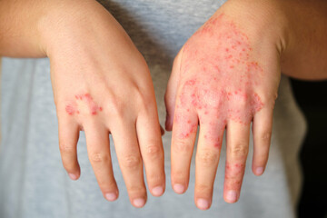 Unrecognizable woman with eczema on hands, atopic dermatitis concept.