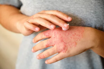 Foto op Canvas Unrecognizable woman applying ointment or moisturizing cream in the treatment of eczema on hand, atopic dermatitis. © Ladanifer