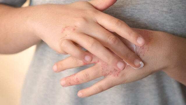 Unrecognizable woman applying ointment or moisturizing cream in the treatment of eczema on hand, atopic dermatitis.