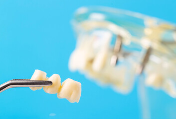 Dental bridge in tweezers against the background of a medical model of the dental jaw, close-up....