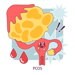 PCOS, polycystic ovary syndrome. Female reproductive system. Endocrine system organ disease. Human hormones secretion imbalance. Flat vector illustration