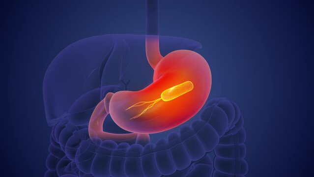 Stomach cancer is caused by the Helicobacter pylori bacterium.