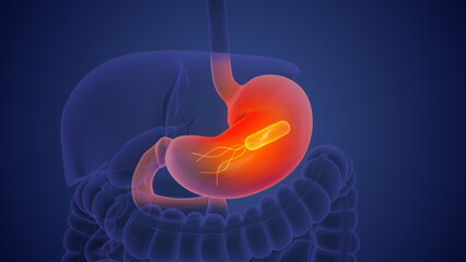 Stomach cancer is caused by the Helicobacter pylori bacterium.
