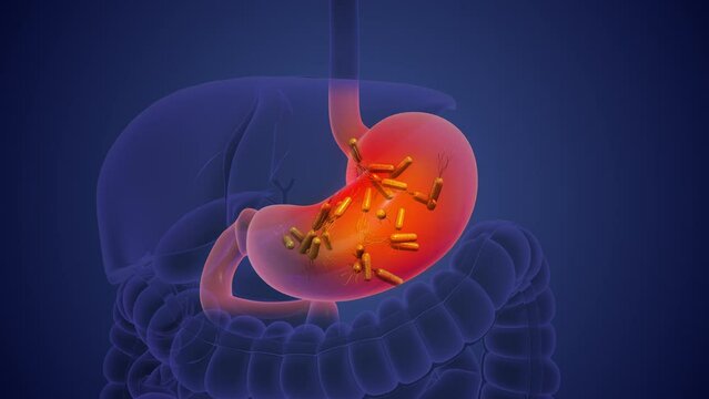 Helicobacter pylori causes chronic inflammation and gastric cancer