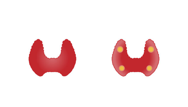 	
Thyroid and parathyroid gland. Anatomy anterior and posterior view of thyroid gland. hypothyroidism vs hyperthyroidism. Vector illustration isolated on white background.