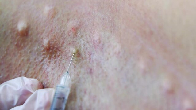 A doctor injects Botox into a patient's armpit to reduce sweating. The concept of beauty and modern technologies.