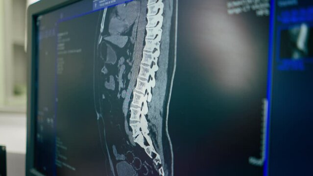 Close-up shot of a detailed image of the spine using magnetic resonance imaging on computer monitor