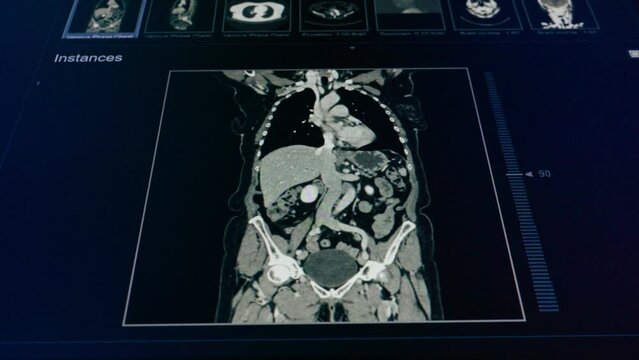 Close-up of a computer monitor showing a picture of the gastrointestinal tract during computed tomography examination