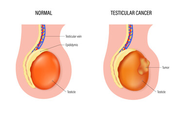 Testicular cancer vector. Comparison of normal testicle and testicular cancer. Testicular disease. Male reproductive system. - obrazy, fototapety, plakaty