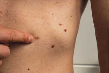 Unrecognizable man showing his birthmarks on skin Close up detail of the bare skin Sun Exposure effect on skin. Health Effects of UV Radiation Male with birthmarks Pigmentation and lot of birthmarks - obrazy, fototapety, plakaty