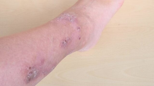 allergic reactions, itchy skin on leg, hives and other skin manifestations, Foot and Leg Conditions, skin problems on general physical and emotional well-being