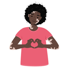 Happy african american woman with vitiligo cosmetology skin disease. Girl with dermatologist spot pigment problem. Body positive illustration. Cartoon Vector illustration