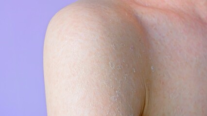 Fototapeta premium Using cream to moisturize dry problem skin of shoulder close up side view cream exfoliation treatment body care medicine and healthcare, skin care with cream and personal hygiene concept