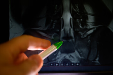 hand showing radiological spine lumbar film with pen in hand - Powered by Adobe